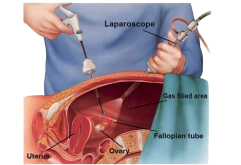 Advanced Laparoscopic Tubal Recanalization